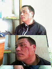 Hình ảnh anh Nguyễn Chí Đức sau khi bị chặn đánh hôm 8 tháng 4 vừa qua. (Source blog Teu)